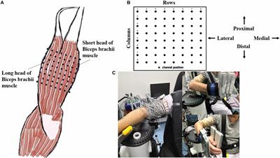 Increased Muscle Activity Accompanying With Decreased Complexity as Spasticity Appears: High-Density EMG-Based Case Studies on Stroke Patients